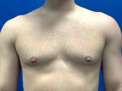 Breast Explant Before & After Patient #5371
