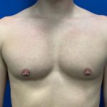 Breast Explant Before & After Patient #5371