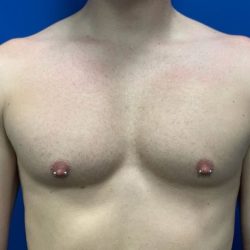 Breast Explant Before & After Patient #5371
