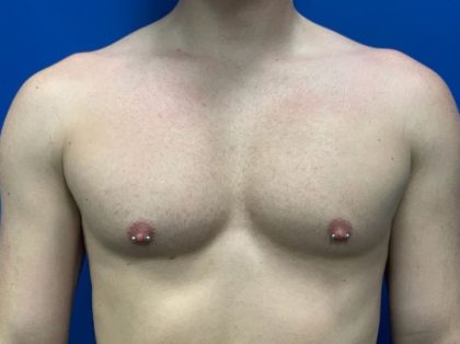 Breast Explant Before & After Patient #5371