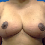 Breast Reduction Before & After Patient #5397