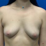 Breast Augmentation Before & After Patient #5428