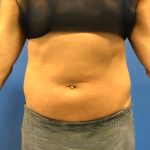 Liposuction Before & After Patient #5450