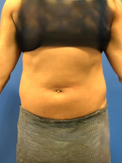 Liposuction Before & After Patient #5450