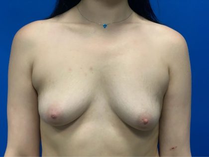 Breast Augmentation Before & After Patient #5428