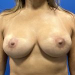 Breast Revision Before & After Patient #5442