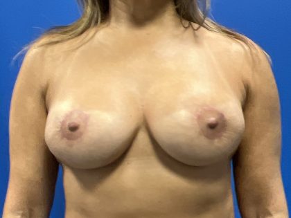 Breast Revision Before & After Patient #5442