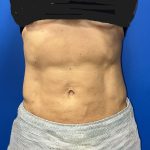 Liposuction Before & After Patient #5450