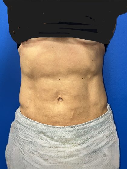 Liposuction Before & After Patient #5450