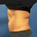 Liposuction Before & After Patient #5450