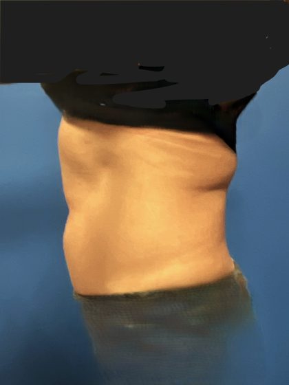 Liposuction Before & After Patient #5450