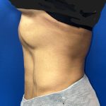 Liposuction Before & After Patient #5450