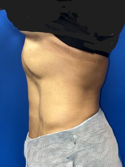 Liposuction Before & After Patient #5450