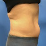 Liposuction Before & After Patient #5450