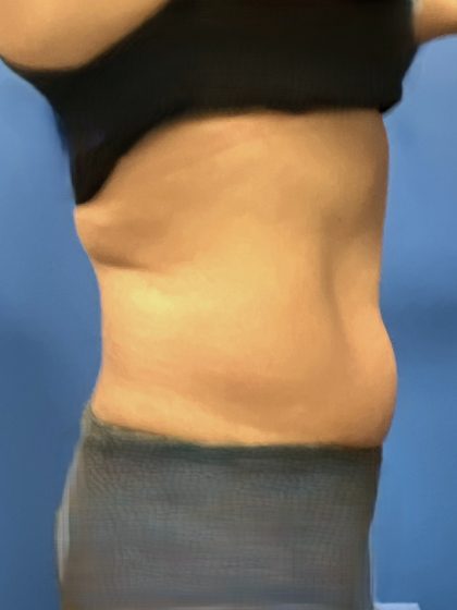 Liposuction Before & After Patient #5450