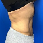 Liposuction Before & After Patient #5450