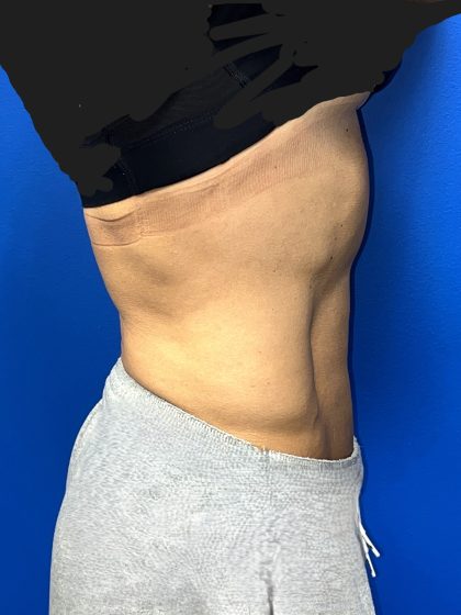 Liposuction Before & After Patient #5450