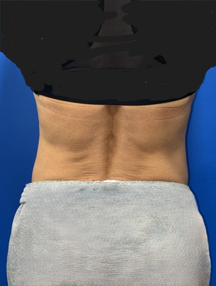 Liposuction Before & After Patient #5450