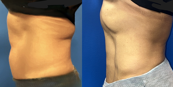 before-after-photo