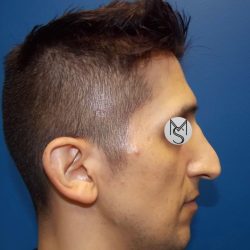 Rhinoplasty Before & After Patient #5487