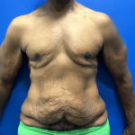 Tummy Tuck Before & After Patient #5495