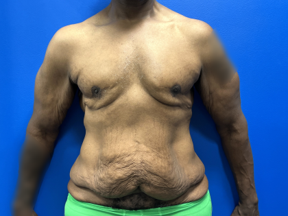 Tummy Tuck Before & After Patient #5495