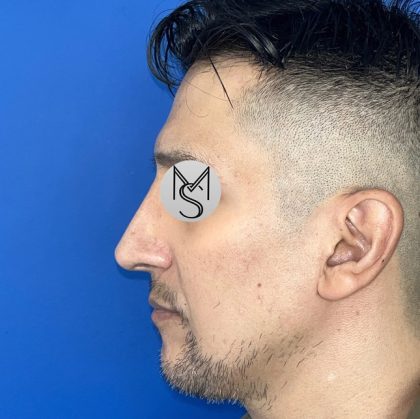 Rhinoplasty Before & After Patient #5487