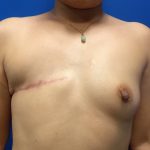 Latissimus Flap with Implant Before & After Patient #5468