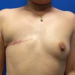 Latissimus Flap with Implant Before & After Patient #5468