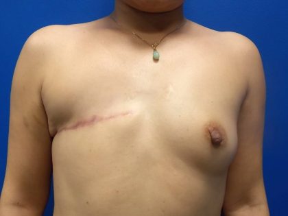 Latissimus Flap with Implant Before & After Patient #5468