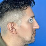 Rhinoplasty Before & After Patient #5487