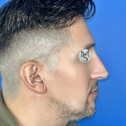 Rhinoplasty Before & After Patient #5487
