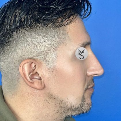Rhinoplasty Before & After Patient #5487