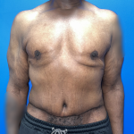 Tummy Tuck Before & After Patient #5495