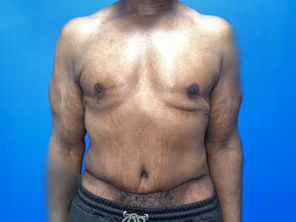 Tummy Tuck Before & After Patient #5495