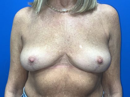 Breast Explant Before & After Patient #5488