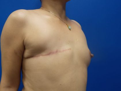 Latissimus Flap with Implant Before & After Patient #5468