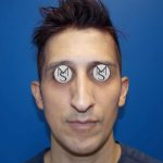 Rhinoplasty Before & After Patient #5487
