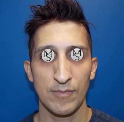 Rhinoplasty Before & After Patient #5487