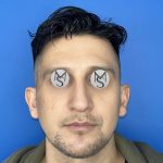 Rhinoplasty Before & After Patient #5487