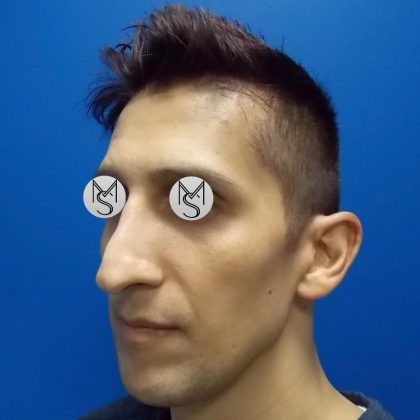 Rhinoplasty Before & After Patient #5487