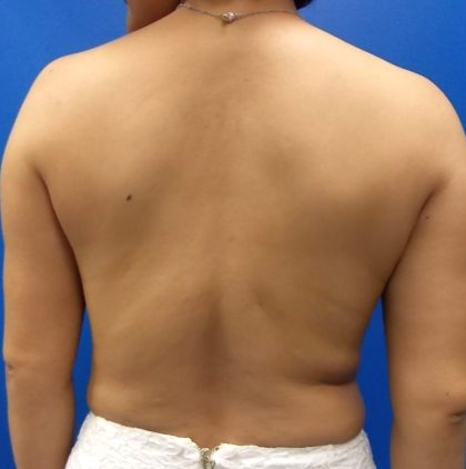 Latissimus Flap with Implant Before & After Patient #5468