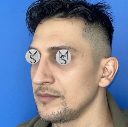Rhinoplasty Before & After Patient #5487