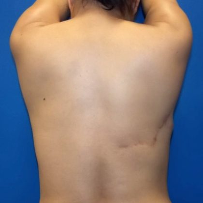 Latissimus Flap with Implant Before & After Patient #5468