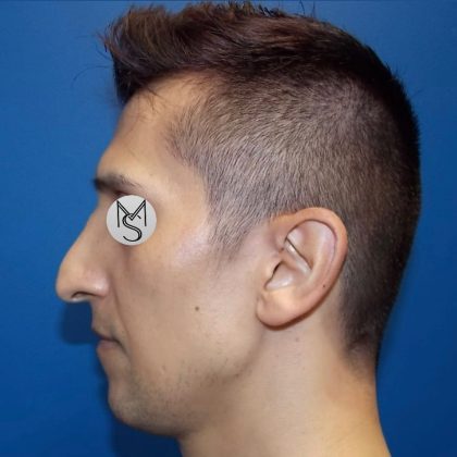 Rhinoplasty Before & After Patient #5487