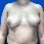 Breast Asymmetry Correction Before & After Patient #5498