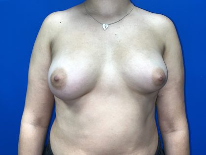 Breast Asymmetry Correction Before & After Patient #5498
