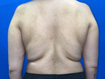 Breast Asymmetry Correction Before & After Patient #5498
