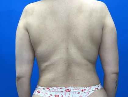 Breast Asymmetry Correction Before & After Patient #5498