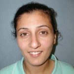 Rhinoplasty Before & After Patient #5532